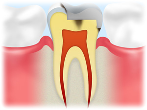 2.破損や虫歯の再発