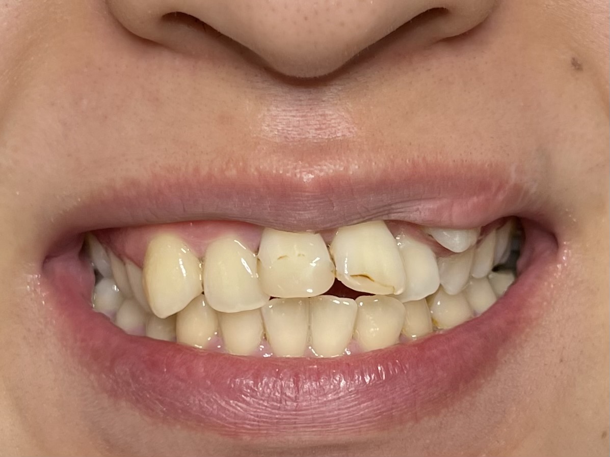 歯の重なり、ガタガタな歯並びの治療①